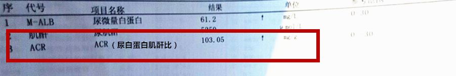 臨床目前最常用尿蛋白肌酐比來反應尿微量白蛋白的水平